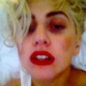 Lady Gaga enseña el resultado del accidente