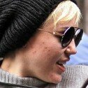 Miley Cyrus sufre acné